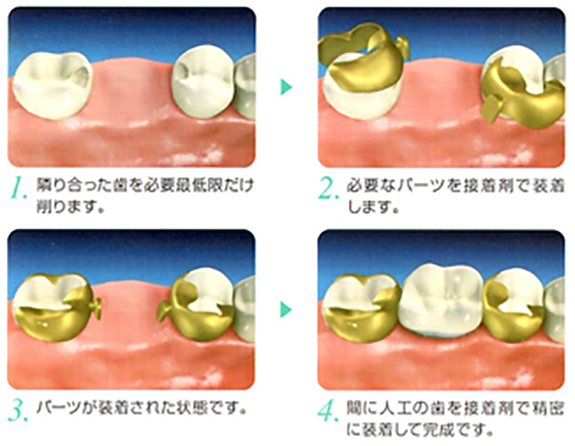 あずま歯科のヒューマンブリッジ治療の流れ